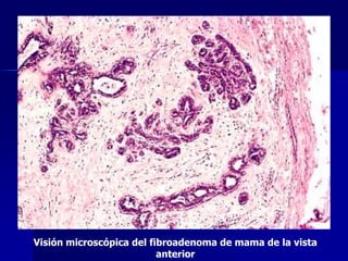 Visión microscópica del fibroadenoma de mama de la vista
anterior
 