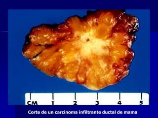 Corte de un carcinoma infiltrante ductal de mama
 