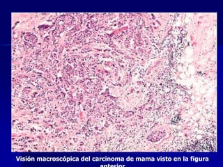 Visión macroscópica del carcinoma de mama visto en la figura
 