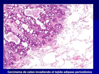Carcinoma de colon invadiendo el tejido adiposo pericolónico
 