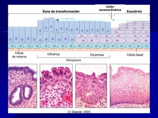 Zona de transformación Exocérvix
Célula
de reserva
Cilíndrica Escamosa Célula basal
Unión
escamocilíndrica
 