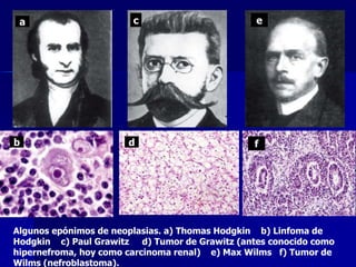 Algunos epónimos de neoplasias. a) Thomas Hodgkin b) Linfoma de
Hodgkin c) Paul Grawitz d) Tumor de Grawitz (antes conocido como
hipernefroma, hoy como carcinoma renal) e) Max Wilms f) Tumor de
Wilms (nefroblastoma).
a
b
c
d
e
f
 