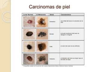Carcinomas de piel
 