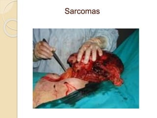 Sarcomas
 