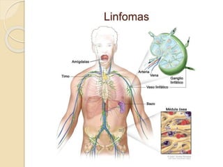 Linfomas
 