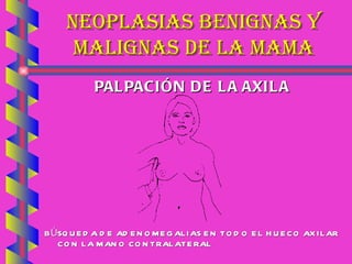 NEOPLASIAS BENIGNAS Y MALIGNAS DE LA MAMA PALPACIÓN DE LA AXILA BÚSQUEDA DE ADENOMEGALIAS EN TODO EL HUECO AXILAR CON LA MANO CONTRALATERAL 