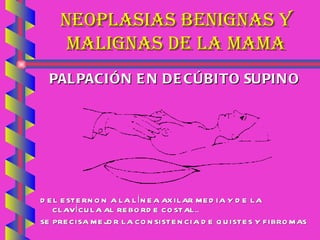 NEOPLASIAS BENIGNAS Y MALIGNAS DE LA MAMA PALPACIÓN EN DECÚBITO SUPINO DEL ESTERNON A LA LÍNEA AXILAR MEDIA Y DE LA CLAVÍCULA AL REBORDE COSTAL.. SE PRECISA MEJOR LA CONSISTENCIA DE QUISTES Y FIBROMAS 