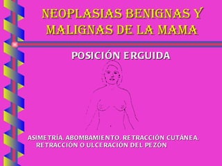 NEOPLASIAS BENIGNAS Y MALIGNAS DE LA MAMA POSICIÓN ERGUIDA ASIMETRÍA, ABOMBAMIENTO, RETRACCIÓN CUTÁNEA, RETRACCIÓN O ULCERACIÓN DEL PEZÓN 