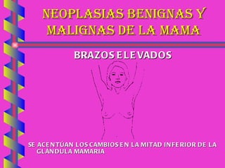 NEOPLASIAS BENIGNAS Y MALIGNAS DE LA MAMA BRAZOS ELEVADOS SE ACENTÚAN LOS CAMBIOS EN LA MITAD INFERIOR DE LA GLÁNDULA MAMARIA 