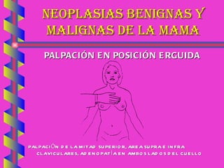 NEOPLASIAS BENIGNAS Y MALIGNAS DE LA MAMA PALPACIÓN EN POSICIÓN ERGUIDA PALPACIÓN DE LA MITAD SUPERIOR, AREA SUPRA E INFRA CLAVICULARES, ADENOPATÍA EN AMBOS LADOS DEL CUELLO  