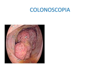 COLONOSCOPIA
 