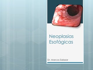 Neoplasias
 Esofágicas


Dr. Marcos Salazar
 