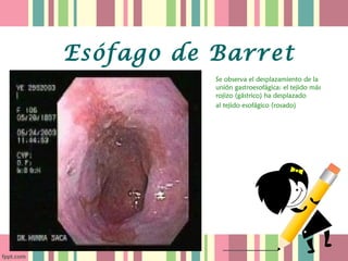 Esófago de Barret
           Se observa el desplazamiento de la
           unión gastroesofágica: el tejido más
           rojizo (gástrico) ha desplazado
           al tejido esofágico (rosado)
 