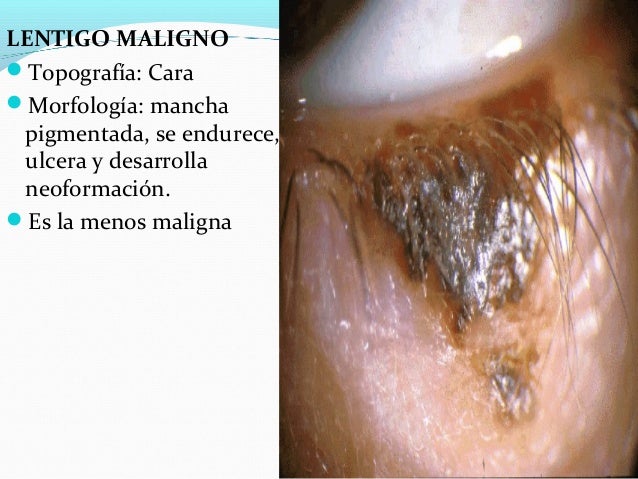 El tratamiento de los papilomas sobre el cuello por el aceite de ricino