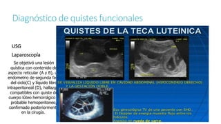 Diagnóstico de quistes funcionales
USG
Laparoscopía
Se objetivó una lesión
quística con contenido de
aspecto reticular (A y B), un
endometrio de segunda fase
del ciclo(C) y líquido libre
intraperitoneal (D), hallazgos
compatibles con quiste de
cuerpo lúteo hemorrágico y
probable hemoperitoneo,
confirmado posteriormente
en la cirugía.
 