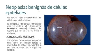 Neoplasias benignas de células
epiteliales
Las células tiene características de
células epiteliales típicas.
La neoplasia de células epiteliales
mas frecuente es el cistoadenoma
(adenoma quístico) seroso. Se
sugiere que tienen escaso potencial
maligno
ADENOMA QUÍSTICO SEROSO.
son quistes uniloculados, de pared
fina, llenos de líquido seroso y
revestidos de células semejantes a
las que recubren las trompas de
Falopio.
 