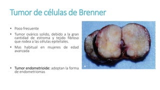 Tumor de células de Brenner
• Poco frecuente
• Tumor ovárico solido, debido a la gran
cantidad de estroma y tejido fibroso
que rodea a las células epiteliales.
• Mas habitual en mujeres de edad
avanzada
• Tumor endometrioide: adoptan la forma
de endometriomas
 