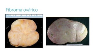 Fibroma ovárico
 