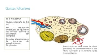 Quistes foliculares
Es el más común
Varían en tamaño de 3-8
cm
Por reabsorción
defectuosa de líquido en
los folículos que no se
desarrollan por
completo
Debido a alteraciones en
la liberación de
gonadotropinas
hipofisarias Revestidos de una capa interna de células
granulosas y por una capa externa de la teca
interna (luteinizadas o no). Contiene líquido
rico en estrógenos.
 