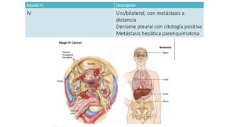 Estadio IV Descripción
IV Uni/bilateral, con metástasis a
distancia
Derrame pleural con citología positiva
Metástasis hepática parenquimatosa
 