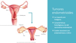 Tumores
endometrioides
 La mayoría son
malignos.
 Características
histológicas a la del
carcinoma endometrial.
 Suelen asociarse con
endometriosis o CACU
 