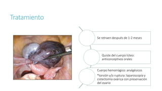 Tratamiento
Se retraen después de 1-2 meses
Quiste del cuerpo lúteo:
anticonceptivos orales
Cuerpo hemorrágico: analgésicos
*torsión y/o ruptura: laparoscopía y
cistectomía ovárica con preservación
del ovario
 