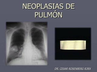 NEOPLASIAS DE
   PULMÓN




       DR. CESAR ROSENBERG R3RX
 