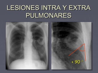 LLEESSIIOONNEESS IINNTTRRAA YY EEXXTTRRAA 
PPUULLMMOONNAARREESS 
<< 9900 ° 
 