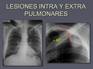 LLEESSIIOONNEESS IINNTTRRAA YY EEXXTTRRAA 
PPUULLMMOONNAARREESS 
>> 9900 ° 
 