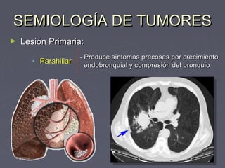 SSEEMMIIOOLLOOGGÍÍAA DDEE TTUUMMOORREESS 
► LLeessiióónn PPrriimmaarriiaa:: 
• PPaarraahhiilliiaarr - PPrroodduuccee ssíínnttoommaass pprreeccoosseess ppoorr ccrreecciimmiieennttoo 
eennddoobbrroonnqquuiiaall yy ccoommpprreessiióónn ddeell bbrroonnqquuiioo 
 