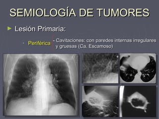 SSEEMMIIOOLLOOGGÍÍAA DDEE TTUUMMOORREESS 
► LLeessiióónn PPrriimmaarriiaa:: 
• PPeerriifféérriiccaa - CCaavviittaacciioonneess:: ccoonn ppaarreeddeess iinntteerrnnaass iirrrreegguullaarreess 
yy ggrruueessaass ((CCaa.. EEssccaammoossoo)) 
 