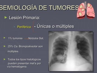 SSEEMMIIOOLLOOGGÍÍAA DDEE TTUUMMOORREESS 
► LLeessiióónn PPrriimmaarriiaa:: 
• PPeerriifféérriiccaa - ÚÚnniiccaass oo mmúúllttiipplleess 
► 11%% ttuummoorreess NNóódduullooss SSaatt.. 
► 2255%% CCaa.. BBrroonnqqiiooaallvveeoollaarr ssoonn 
mmúúllttiipplleess.. 
► TTooddooss llooss ttiippooss hhiissttoollóóggiiccooss 
ppuueeddeenn pprreesseennttaarr mmeett’’ss ppoorr 
vvííaa hheemmaattóóggeennaa.. 
 