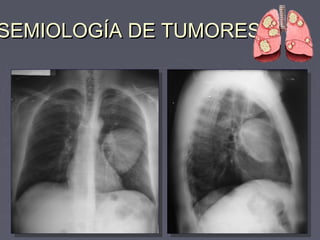 SSEEMMIIOOLLOOGGÍÍAA DDEE TTUUMMOORREESS 
 