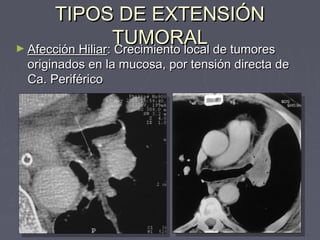 TTIIPPOOSS DDEE EEXXTTEENNSSIIÓÓNN 
TTUUMMOORRAALL ►AAffeecccciióónn HHiilliiaarr:: CCrreecciimmiieennttoo llooccaall ddee ttuummoorreess 
oorriiggiinnaaddooss eenn llaa mmuuccoossaa,, ppoorr tteennssiióónn ddiirreeccttaa ddee 
CCaa.. PPeerriifféérriiccoo 
 