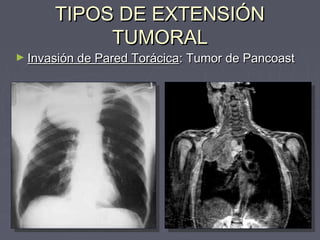 TTIIPPOOSS DDEE EEXXTTEENNSSIIÓÓNN 
TTUUMMOORRAALL 
►IInnvvaassiióónn ddee PPaarreedd TToorráácciiccaa:: TTuummoorr ddee PPaannccooaasstt 
 