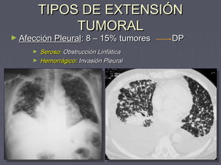 TTIIPPOOSS DDEE EEXXTTEENNSSIIÓÓNN 
TTUUMMOORRAALL 
►AAffeecccciióónn PPlleeuurraall:: 88 –– 1155%% ttuummoorreess DDPP 
► SSeerroossoo:: OObbssttrruucccciióónn LLiinnffááttiiccaa 
► HHeemmoorrrráággiiccoo:: IInnvvaassiióónn PPlleeuurraall 
 