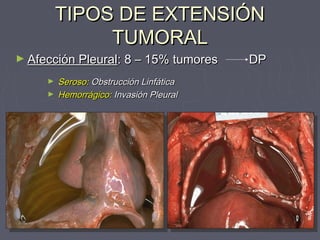 TTIIPPOOSS DDEE EEXXTTEENNSSIIÓÓNN 
TTUUMMOORRAALL 
►AAffeecccciióónn PPlleeuurraall:: 88 –– 1155%% ttuummoorreess DDPP 
► SSeerroossoo:: OObbssttrruucccciióónn LLiinnffááttiiccaa 
► HHeemmoorrrráággiiccoo:: IInnvvaassiióónn PPlleeuurraall 
 