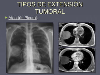 TTIIPPOOSS DDEE EEXXTTEENNSSIIÓÓNN 
TTUUMMOORRAALL 
►AAffeecccciióónn PPlleeuurraall:: 
 