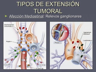 TTIIPPOOSS DDEE EEXXTTEENNSSIIÓÓNN 
TTUUMMOORRAALL 
► AAffeecccciióónn MMeeddiiaassttiinnaall:: RReelleevvooss ggaanngglliioonnaarreess 
 