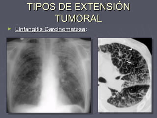 TTIIPPOOSS DDEE EEXXTTEENNSSIIÓÓNN 
TTUUMMOORRAALL 
► LLiinnffaannggiittiiss CCaarrcciinnoommaattoossaa:: 
 