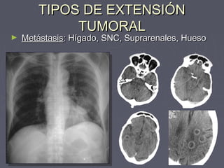 TTIIPPOOSS DDEE EEXXTTEENNSSIIÓÓNN 
TTUUMMOORRAALL 
► MMeettáássttaassiiss:: HHííggaaddoo,, SSNNCC,, SSuupprraarreennaalleess,, HHuueessoo 
 