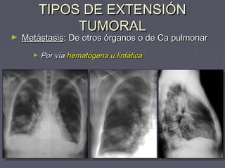 TTIIPPOOSS DDEE EEXXTTEENNSSIIÓÓNN 
TTUUMMOORRAALL 
► MMeettáássttaassiiss:: DDee oottrrooss óórrggaannooss oo ddee CCaa ppuullmmoonnaarr 
► PPoorr vvííaa hheemmaattóóggeennaa uu lliinnffááttiiccaa 
 