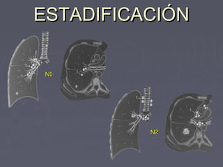 EESSTTAADDIIFFIICCAACCIIÓÓNN 
NN11 
NN22 
 
