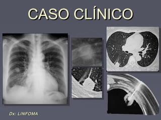 CCAASSOO CCLLÍÍNNIICCOO 
DDxx:: LLIINNFFOOMMAA 
 