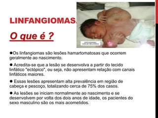 LINFANGIOMAS.
O que é ?
Os linfangiomas são lesões hamartomatosas que ocorrem
geralmente ao nascimento.
 Acredita-se que a lesão se desenvolva a partir do tecido
linfático "ectópico", ou seja, não apresentam relação com canais
linfáticos maiores.
 Essas lesões apresentam alta prevalência em região de
cabeça e pescoço, totalizando cerca de 75% dos casos.
 As lesões se iniciam normalmente ao nascimento e se
desenvolvem por volta dos dois anos de idade, os pacientes do
sexo masculino são os mais acometidos.
 
