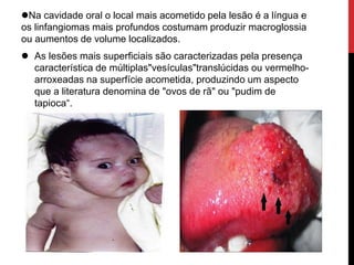 Na cavidade oral o local mais acometido pela lesão é a língua e
os linfangiomas mais profundos costumam produzir macroglossia
ou aumentos de volume localizados.
 As lesões mais superficiais são caracterizadas pela presença
característica de múltiplas"vesículas"translúcidas ou vermelho-
arroxeadas na superfície acometida, produzindo um aspecto
que a literatura denomina de "ovos de rã" ou "pudim de
tapioca“.
 