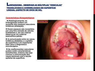 Características Histopatológicas
 Histologicamente, os
linfangiomas exibem um
aumento dos espaços vasculares
linfáticos (dilatação).
 Esses espaços são revestidos
por uma fina camada de células
endoteliais e, em seu interior
observa-se um material
eosinofílico pálido.
 A comunicação entre os vasos
linfáticos dilatados e o epitélio
de superfície é um importante
fator para o diagnóstico
microscópico.
 As malformações vasculares
podem exibir características
semelhantes, embora não seja
comum a comunicação dos
vasos lesionais com o tecido
epitelial de superfície.
LINFANGIOMA - OBSERVAR AS MÚLTIPLAS "VESICULAS"
TRANSLÚCIDAS E AVERMELHADAS EM SUPERFÍCIE
LINGUAL (ASPECTO DE OVOS DE RÃ).
 