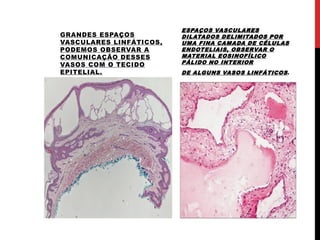 .
GRANDES ESPAÇOS
VASCULARES LINFÁTICOS,
PODEMOS OBSERVAR A
COMUNICAÇÃO DESSES
VASOS COM O TECIDO
EPITELIAL.
ESPAÇOS VASCULARES
DILATADOS DELIMITADOS POR
UMA FINA CAMADA DE CÉLULAS
ENDOTELIAIS, OBSERVAR O
MATERIAL EOSINOFÍLICO
PÁLIDO NO INTERIOR
DE ALGUNS VASOS LINFÁTICOS.
.
 