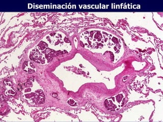 Diseminación vascular linfática 