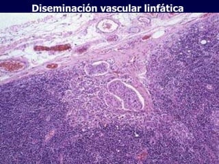 Diseminación vascular linfática 